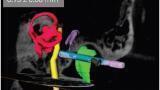 Thermal Cameras Help to Reduce the Invasiveness of Cochlear Implant Surgery