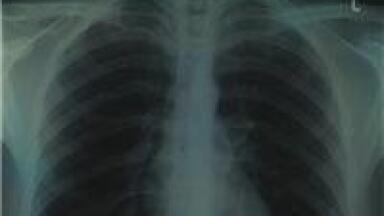 GC-MS reveals biomarker for CF Ps aeruginosa infections
