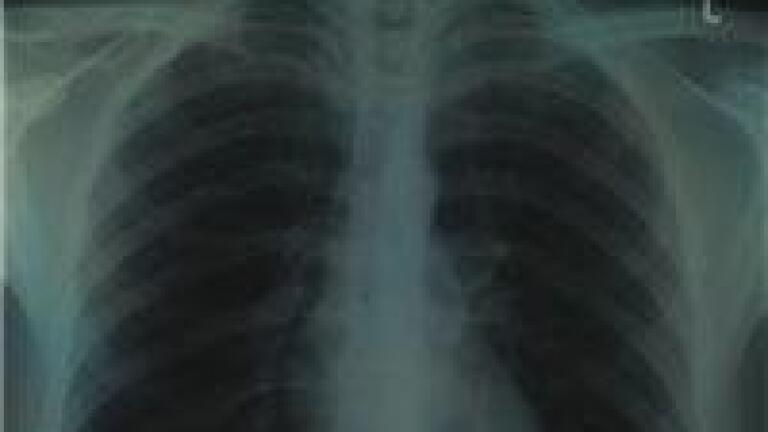 GC-MS reveals biomarker for CF Ps aeruginosa infections