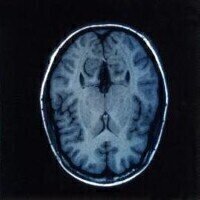 HPLC suggests link between IDO and post-stroke cognitive damage