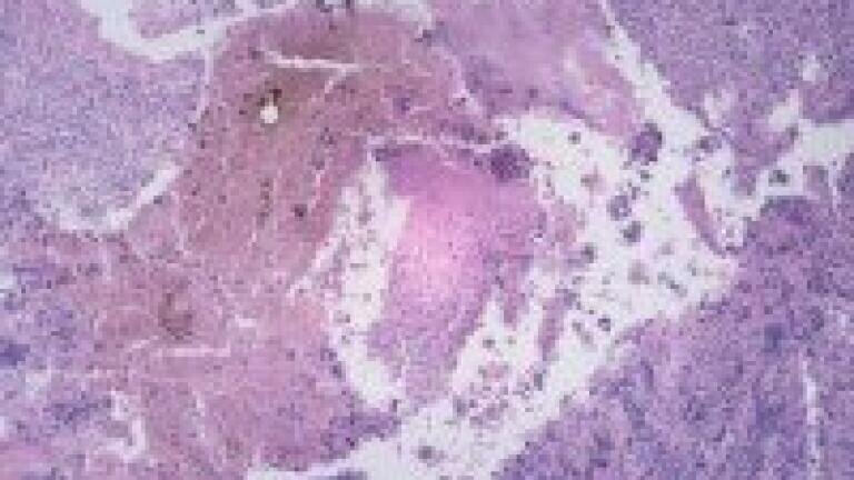 Effect of FWGE on human cancer cells studied with quantitative analysis