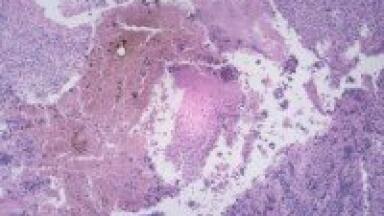 HPLC/MS used in cancer study