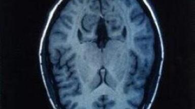 Three distinguishable clinical forms of MLD found