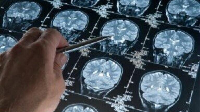 Newly identified metabolic signatures may offer personalised therapy for brain tumours