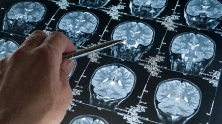 Alzheimer's treatment success moves it onto Phase 3 clinical testing