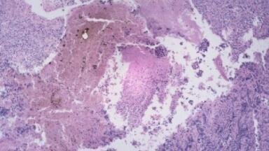 Implantable vaccine could be 'key to skin cancer treatment'