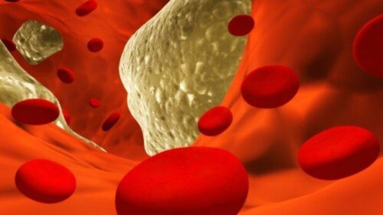 Cholesterol lowering drug performs well in clinical trial