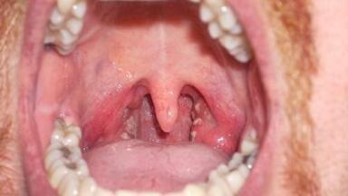 Dry mouth treatment in cancer patients shows positive trial results