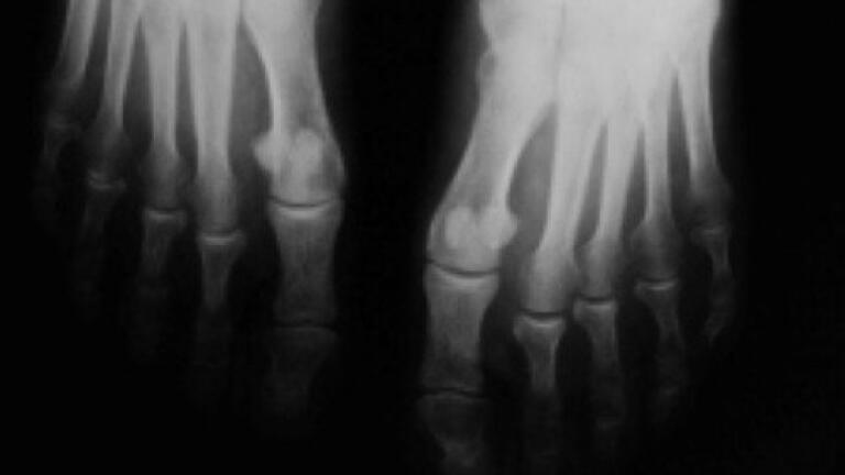 Faulty DNA found to 'cause arthritis'