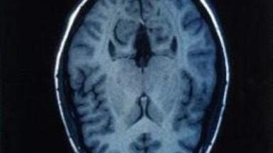 Potential drug targets for brain tumours found