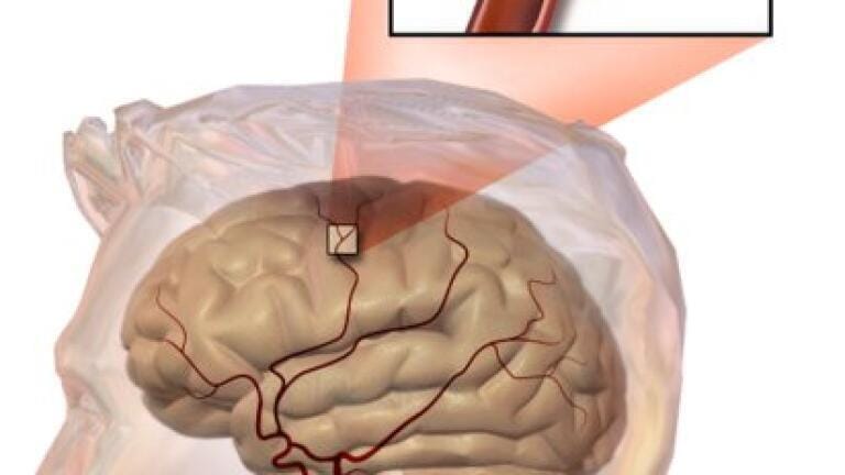 Stroke — Can Chromatography Help Recovery?