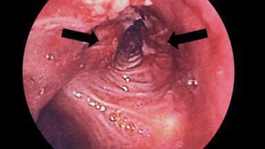 Early-Stage Lung Cancer Detection by GC
