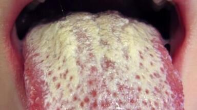 Fighting Fungal Infections with Chromatography