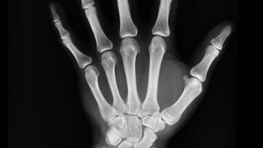 How Does Diabetes Affect Bone Turnover? - Chromatography Explores