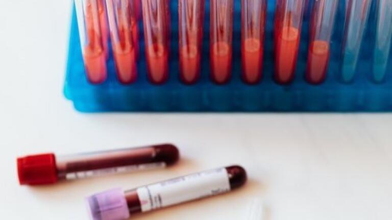 What is Porphyria and How Can Chromatography Help?